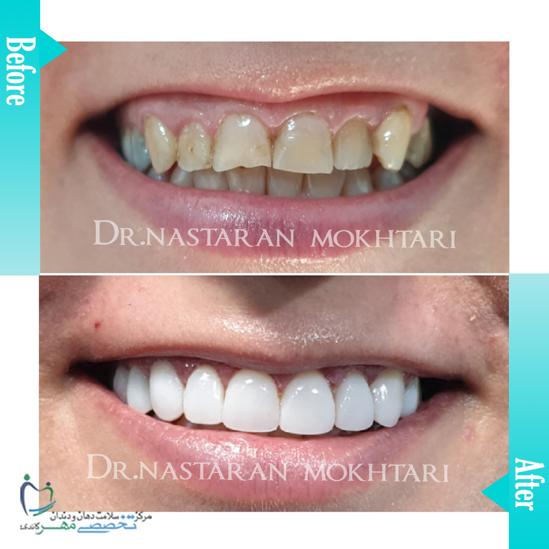 دکتر نسترن مختاری - متخصص ترميمی و زیبایی (کامپوزیت ونیر / لمینیت کامپوزیتی)